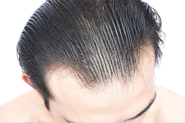 Tips against thinning hair for men Tips against thinning hair for men